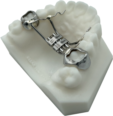 A 3D-printed rapid palatal expander on a printed model